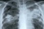 Над 4000 души с рак на белия дроб за 1 г. в България