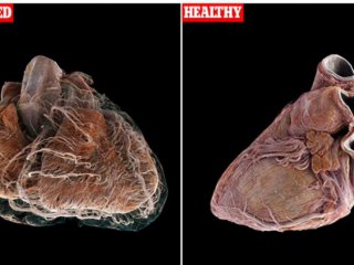 Шокиращо видео разкри разликата между здраво сърце и на пациент със сърдечносъдово заболяване